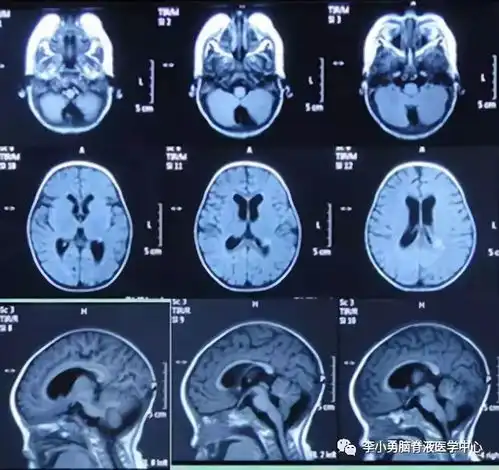  心疼,1岁多宝宝脑膜炎发热4个月疑似脑肿瘤,辗转9家医院