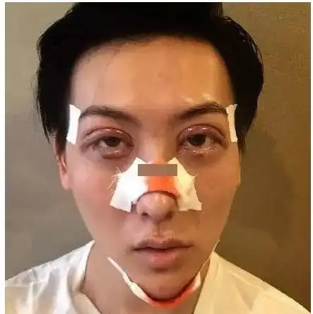  59岁关之琳疑似整容失败面部僵硬苹果肌下垂,近照脸崩太吓人
