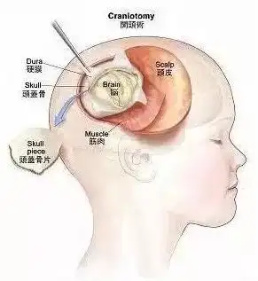  神经外科齐林团队,不食不休14个小时,为13岁少年打赢一场漂亮的脑癌攻坚战