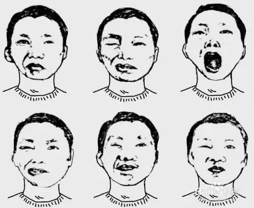  中医李燕冬季面瘫高发期,孩子扮鬼脸家长要小心